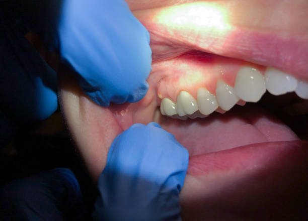 Best Emergency Root Canal Treatment in Lena, IL