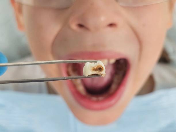 Best Emergency Dentist for Knocked-Out Tooth in Lena, IL